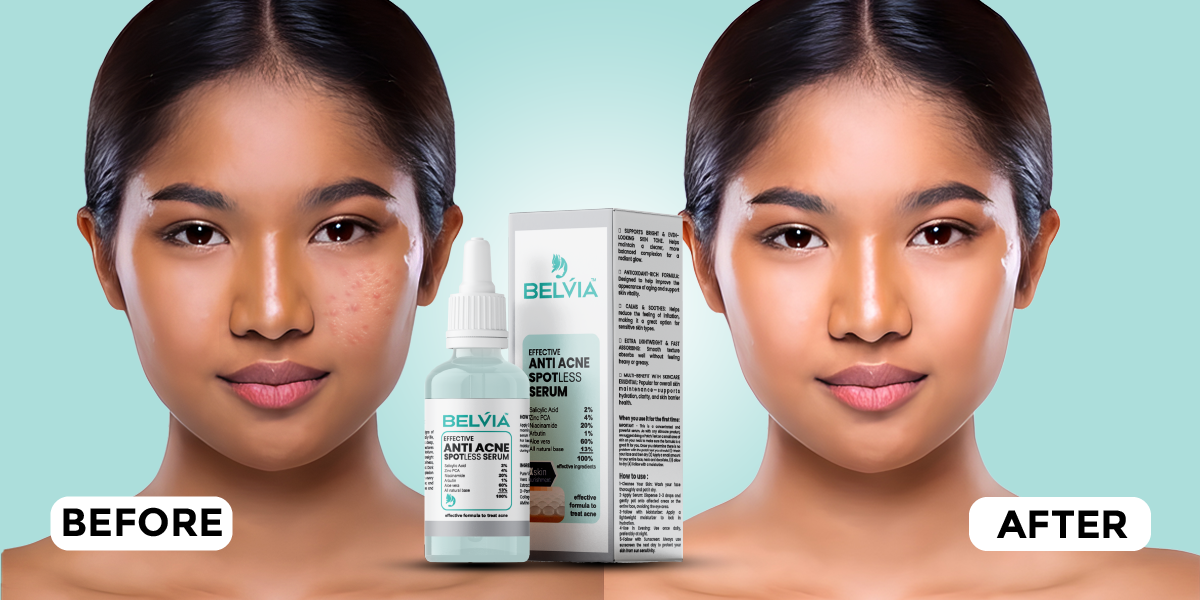 AntiAcne-EBC-5